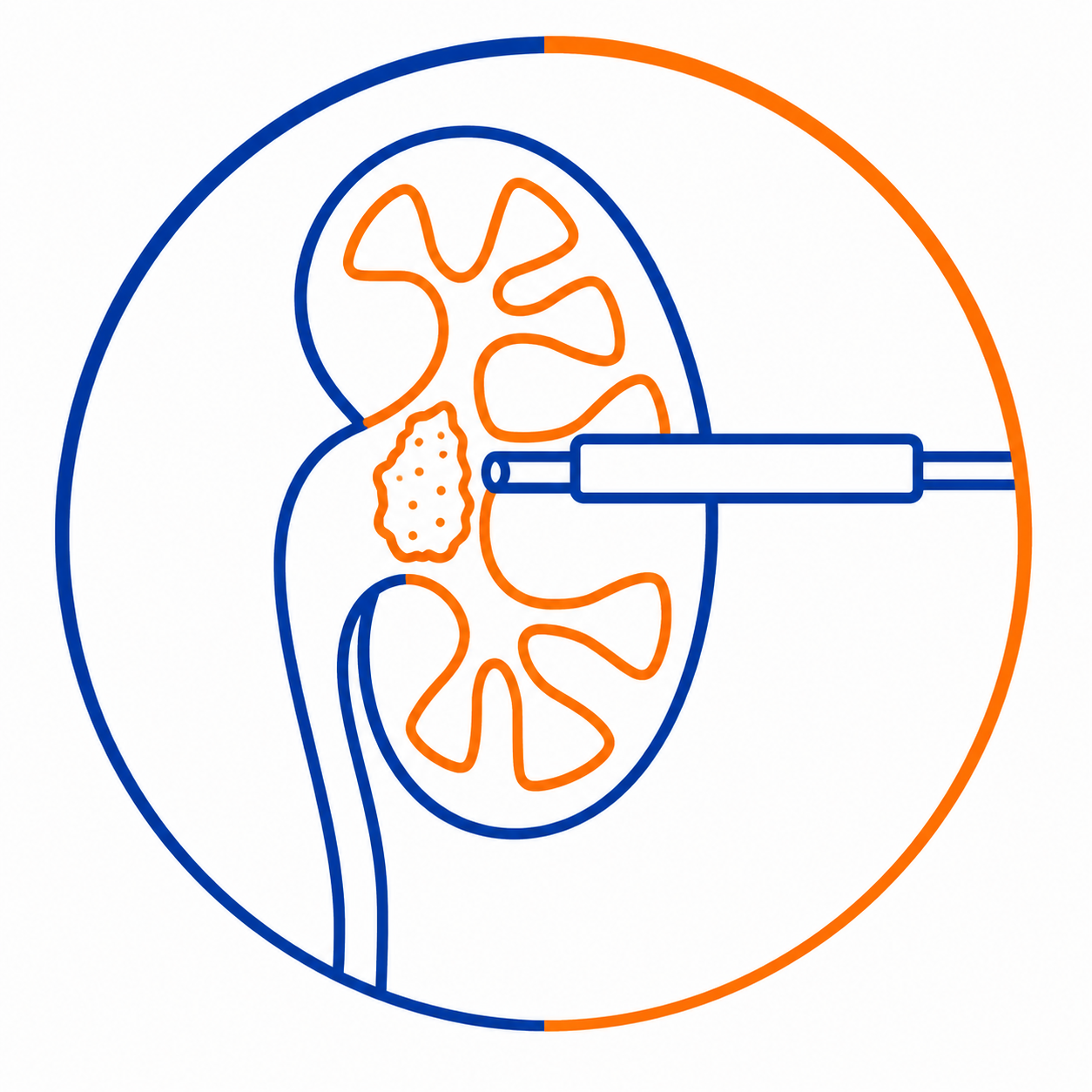 Endourology Stone Management