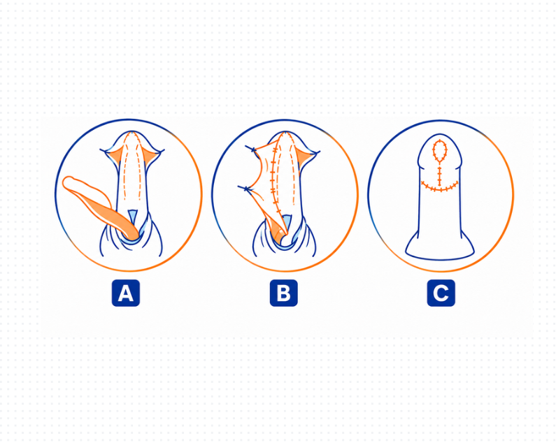Reconstructive Urology